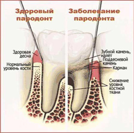 Лечение пародонтоза