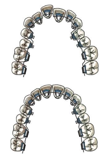 Лечение на лингвальной брекет-системе STb