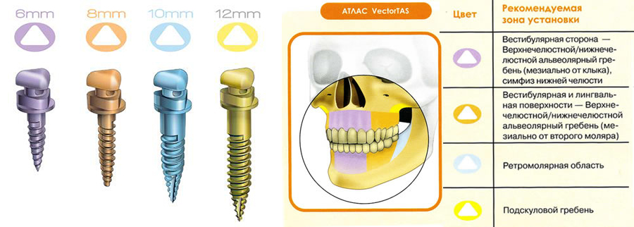 Установка ортодонтического мини-имплантата Vector Tas